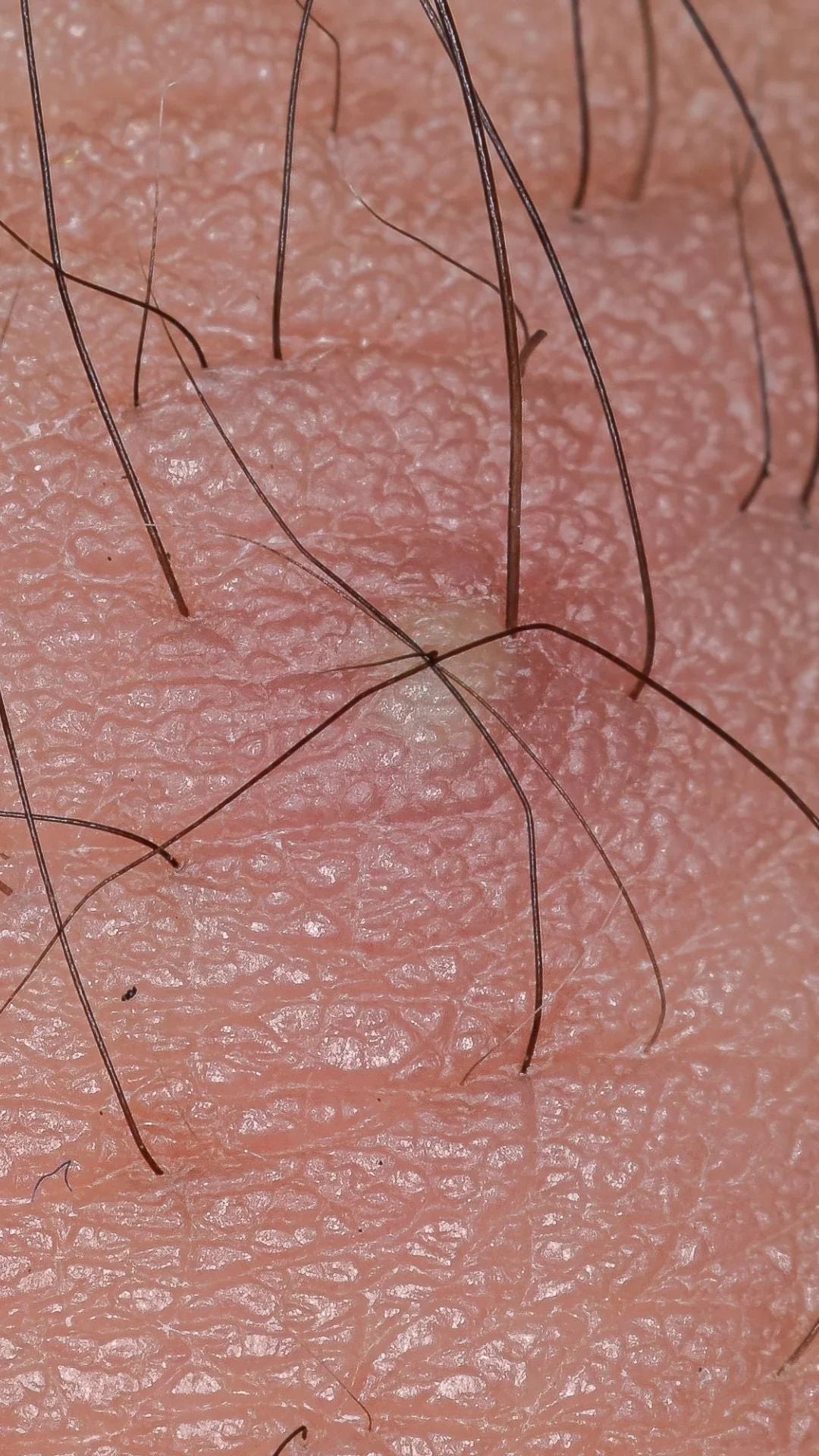 Poils incarnés : comment le gommage exfoliant traite et élimine le problème efficacement