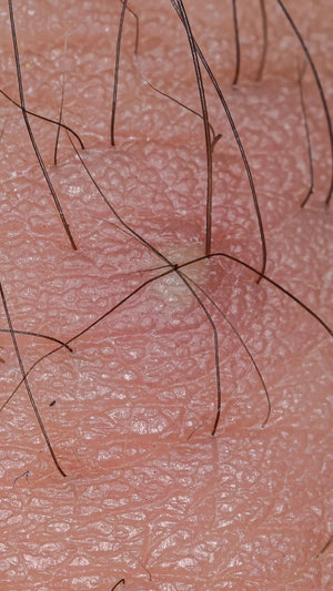 Poils incarnés : comment le gommage exfoliant traite et élimine le problème efficacement