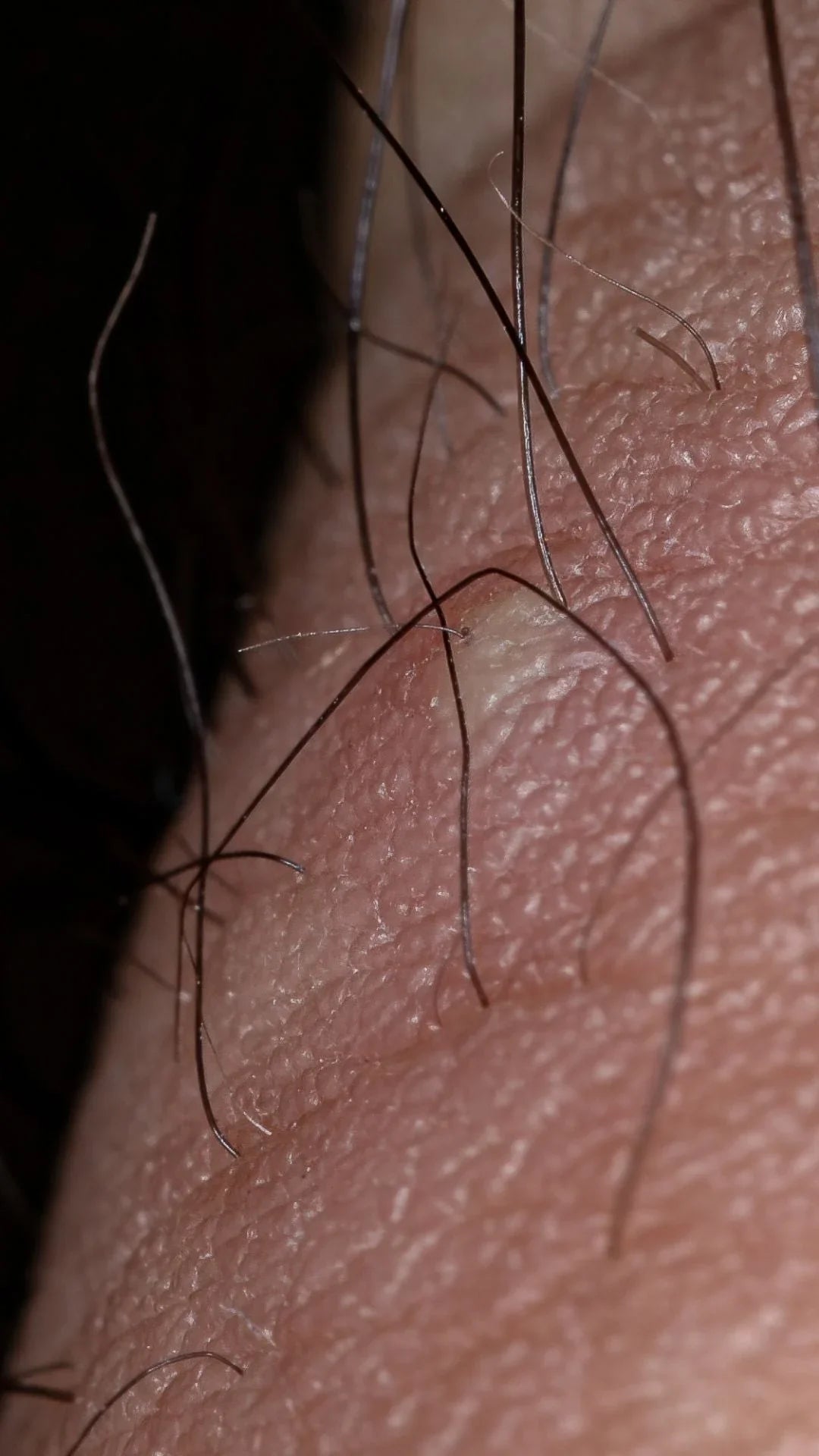 Poils Incarnés : comment le gommage corporel prévient ce problème cutané de façon efficace