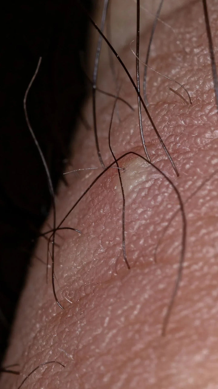 Poils Incarnés : comment le gommage corporel prévient ce problème cutané de façon efficace