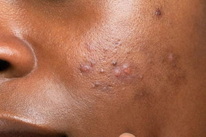 Tache noire sur la peau noire : comprendre, prévenir et atténuer