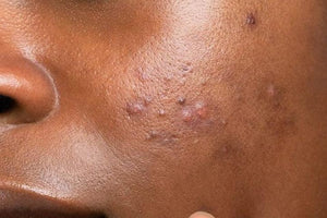 Hyperpigmentation Peau Noire : Comment Atténuer les Taches Sombres et Unifier le Teint Naturellement