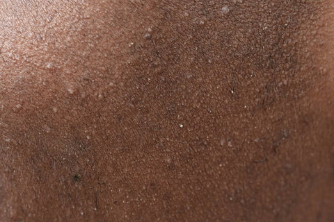 Kératose pilaire : comment s'en débarrasser quand on a la peau noire ou métissée ?