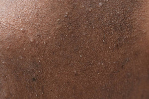 Kératose pilaire : comment s'en débarrasser quand on a la peau noire ou métissée ?